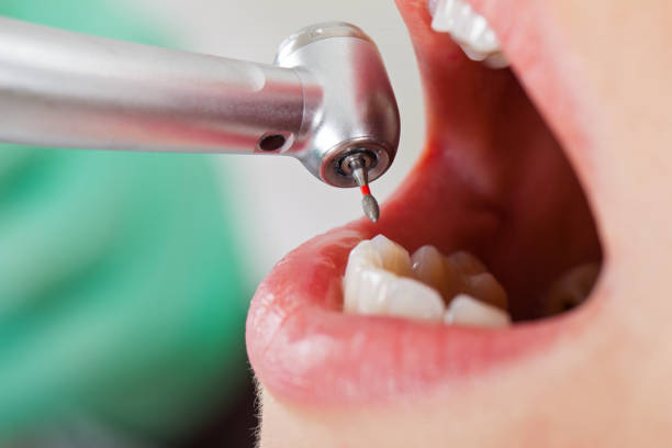 Best Emergency Tooth Extraction in Marlin, TX